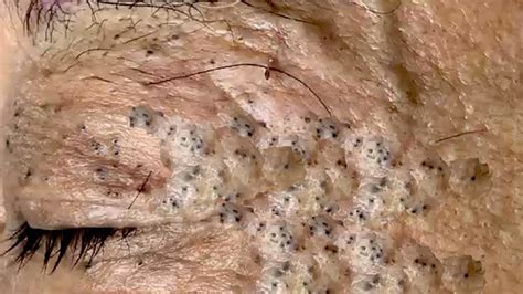 blackheads 2021 new videos|blackhead extraction videos 2021.